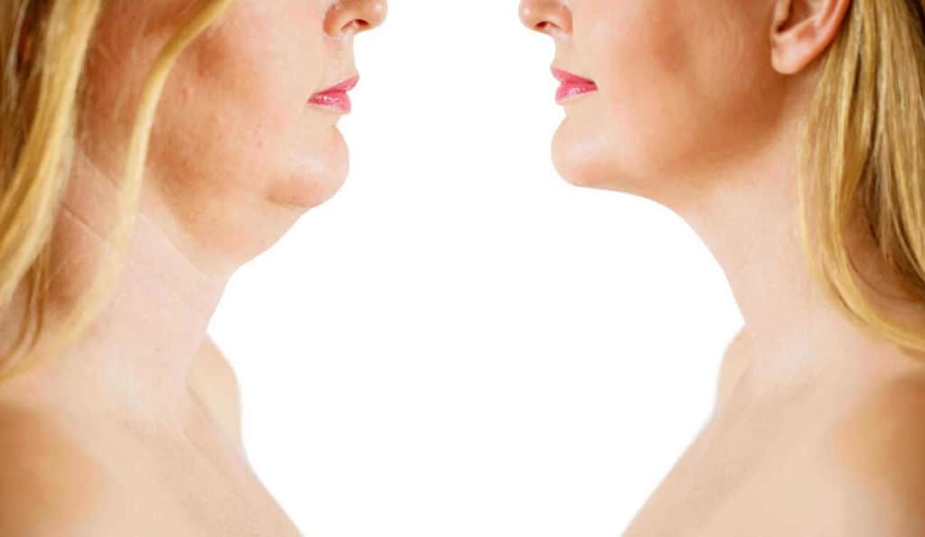 Double Chin treatment Slough before and after results