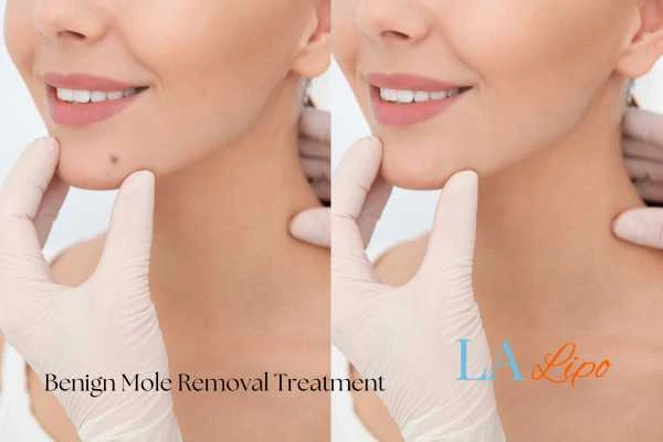 woman's before and after mole removal Slough results