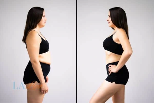 image of woman before and after results of LA-EMS Body Sculpting Slough to help treat Diastasis recti