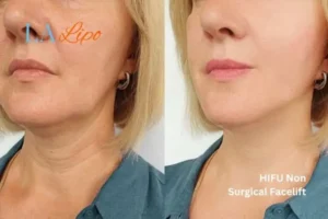 hi-fu for wrinkles Slough before and after results
