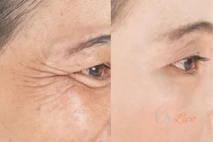 Before and after results of woman - HI-fu wrinkles reduction treatment Slough