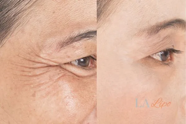 Before and after results of woman - HI-fu wrinkles reduction treatment Slough