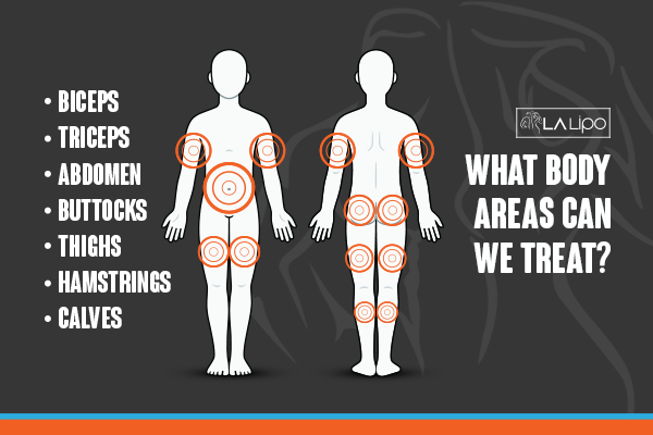 Graphic to show areas you can have LA-EMS Body Sculpting Slough treatment.