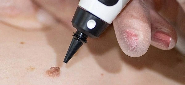 skin tag removal using cryopen Slough