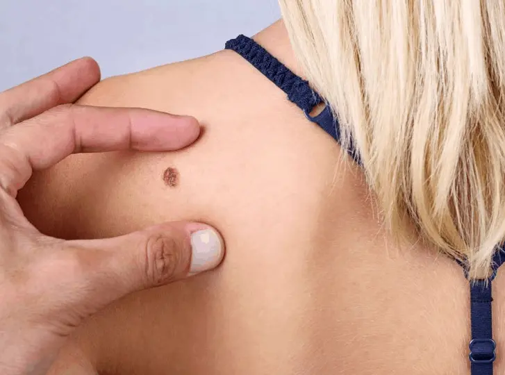 woman having mole removal Slough consultation before treatment.