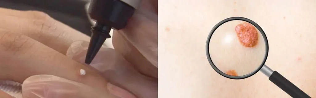 Cryopen for mole removal Slough - speak to our team today!