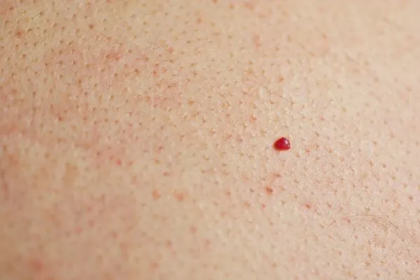 close up of a cherry angioma Slough