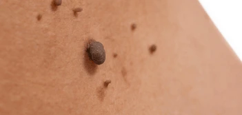 image of a skin tag Slough