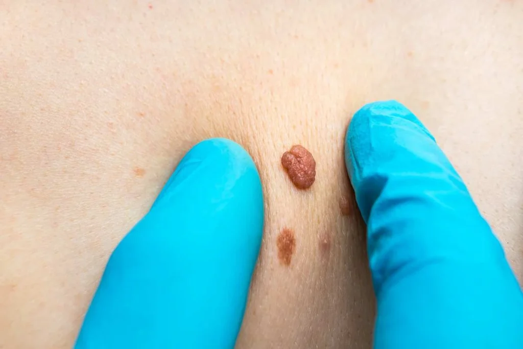 Consultant examining a skin tag Slough