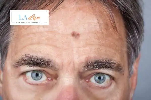 Solar Lentigo Removal Slough image of man with mark on his forehead