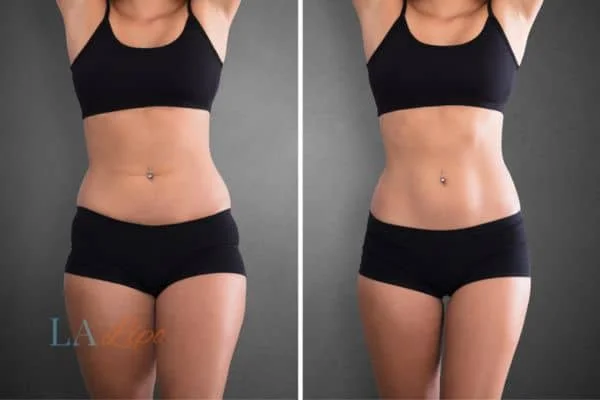 before and after results of non-surgical treatment to help a woman's body image and mental health Slough