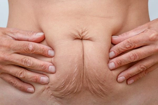 Image of a woman's stomach with loose skin - example of skin tightening Slough options