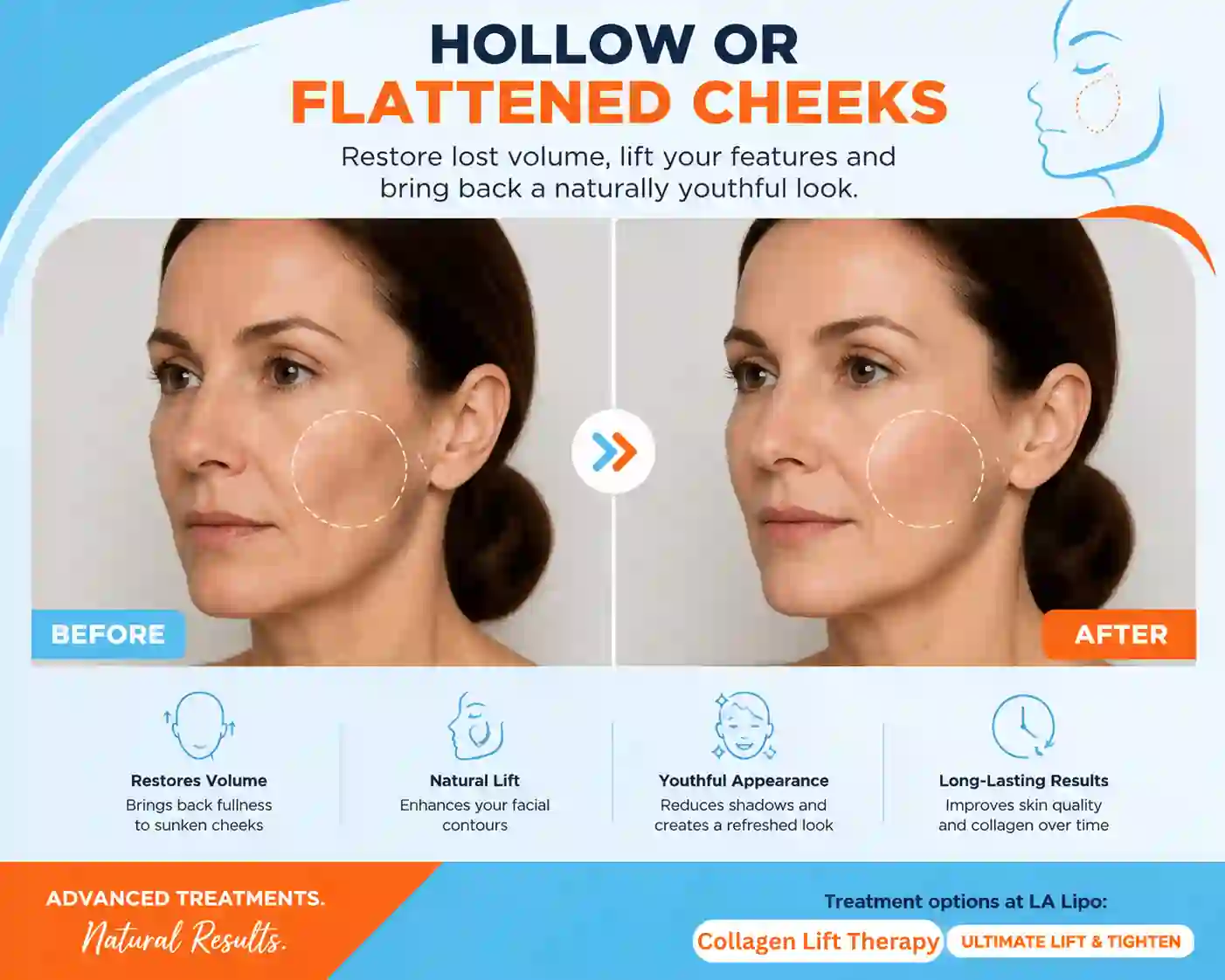 Sign #4: Hollow or Flattened Cheeks Slough