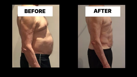 What Symptoms Can Diastasis Recti Cause in Men? Weak Core, Back Pain and Poor Posture Slough